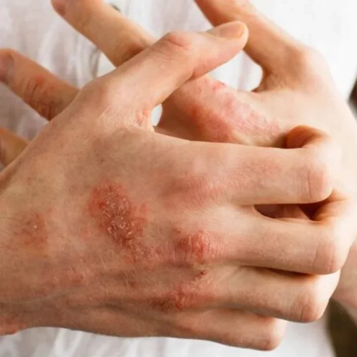 Psoriasis: la intervención temprana puede cambiar el curso de esta enfermedad crónica
