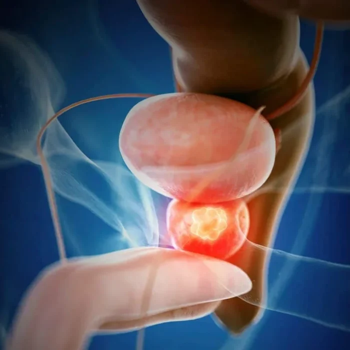 Cáncer de próstata: la incidencia disminuyó en un 40% entre 2007 y 2014 y ahora aumentó un 3% anual