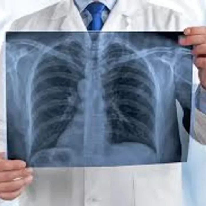 Cáncer de Pulmón: alertan sobre el aumento de casos