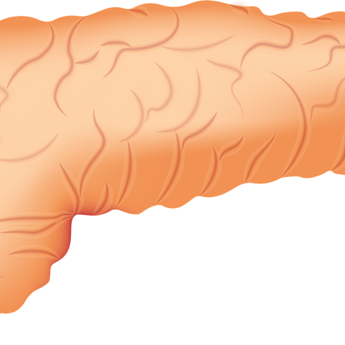 Cáncer de páncreas: la clave es identificar los factores de riesgo Cáncer de páncreas: la clave es identificar los factores de riesgo