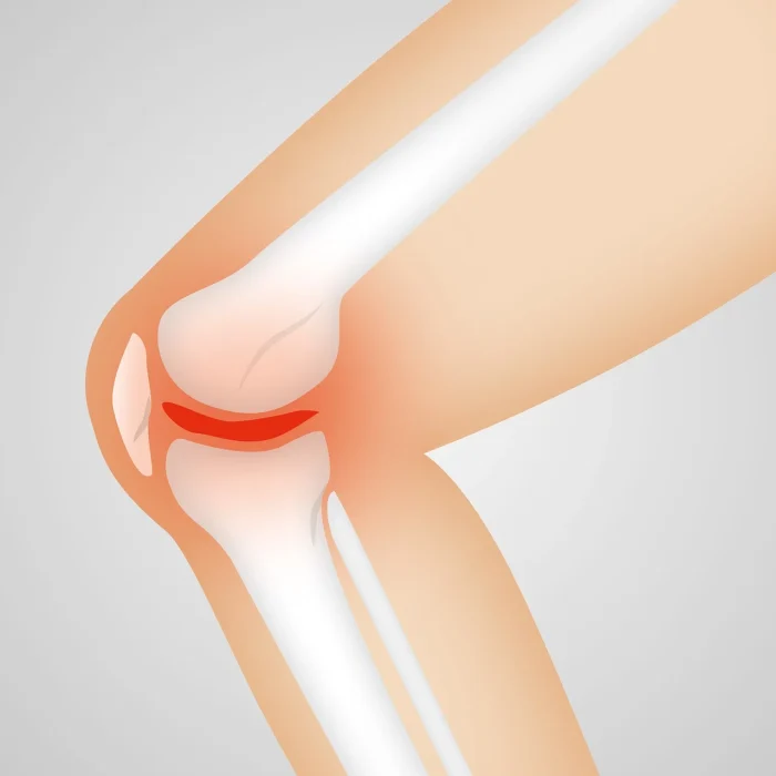 Artrosis: científicos de Stanford lograron revertir el daño del cartílago y regenerar el tejido Artrosis: científicos de Stanford lograron revertir el daño del cartílago y regenerar el tejido