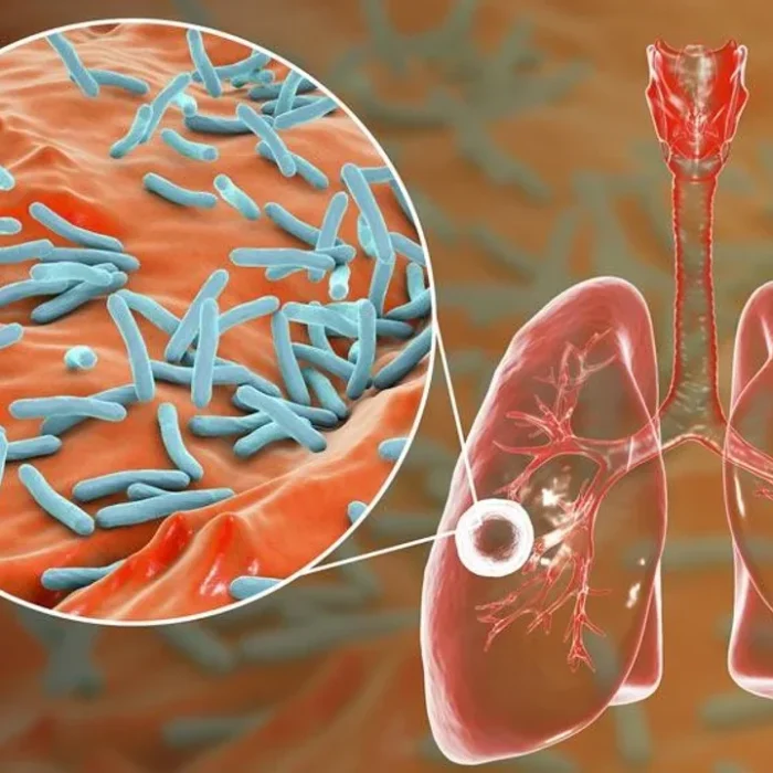 Tuberculosis: actualizaciones sobre una de las principales causas de muerte por agentes infecciosos