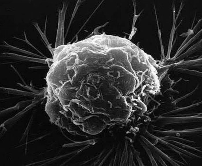 Avance en diagnóstico de cáncer de mama