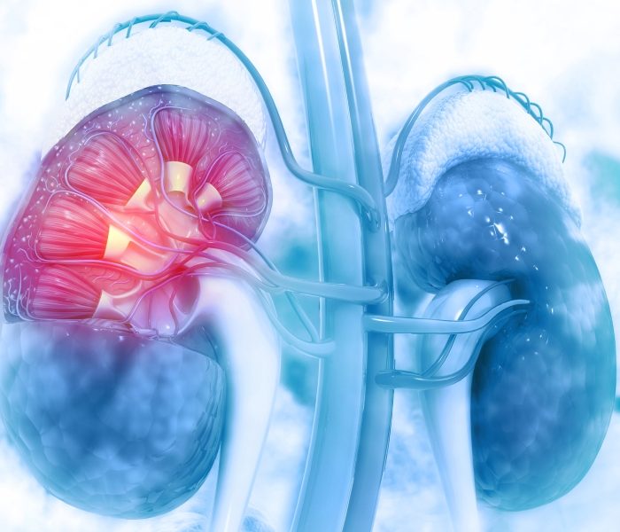 En Argentina, el 10 por ciento de la población tiene alguna complicación renal