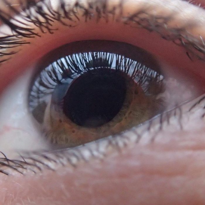 El glaucoma afecta a más de 80 millones de personas en el mundo