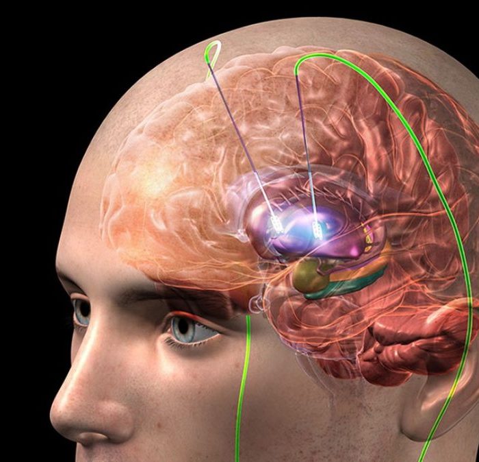 Estimulación cerebral profunda: una cirugía que puede mejorar la calidad de vida Estimulación cerebral profunda: una cirugía que puede mejorar la calidad de vida