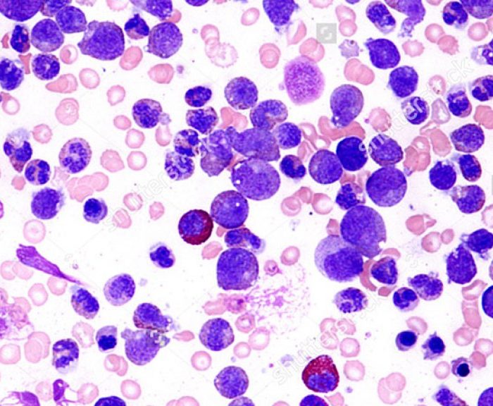 Cambió el paradigma de tratamiento de la leucemia y logran resultados inéditos