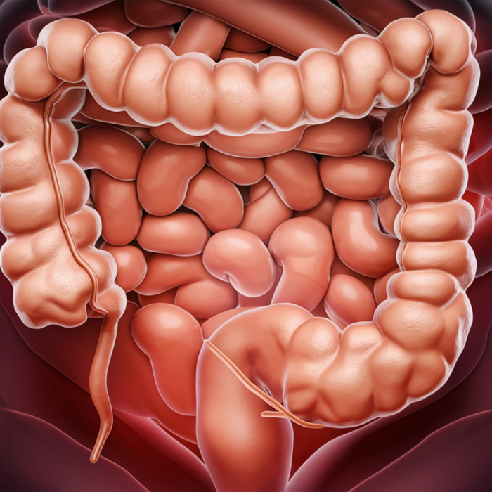 Los 4 factores detrás del aumento del cáncer de intestino en jóvenes
