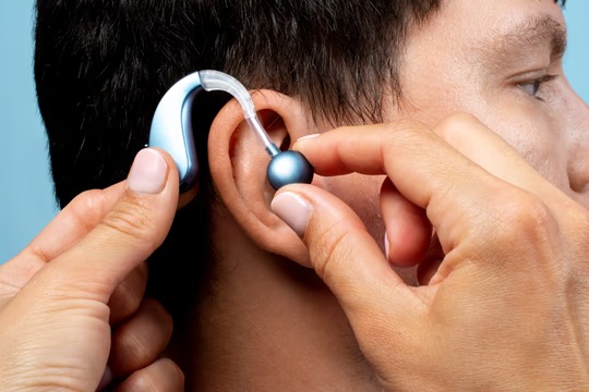 Implantes cocleares: qué cambian estos dispositivos para la audición Implantes cocleares: qué cambian estos dispositivos para la audición