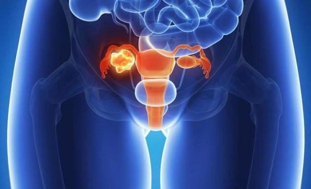 El cáncer de ovario podría originarse en las trompas de Falopio El cáncer de ovario podría originarse en las trompas de Falopio