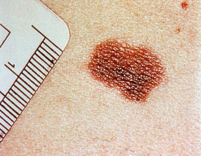 Alarma por el aumento de casos de melanoma entre los jóvenes Alarma por el aumento de casos de melanoma entre los jóvenes