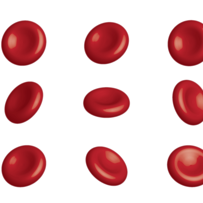 1 de cada 3 pacientes con mielofibrosis presenta anemia al momento del diagnóstico